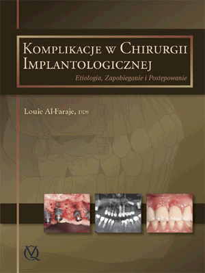 Komplikacje w chirurgii implantologicznej. Etiologia, Zapobieganie i Postępowanie