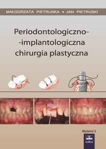 Periodontologiczno-implantologiczna chirurgia plastyczna