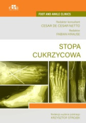 Stopa cukrzycowa