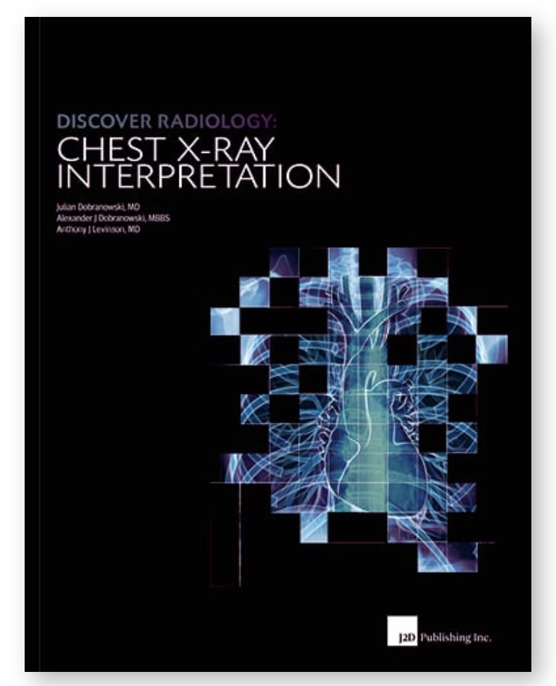 CHEST X-RAY Interpretation, Discover Radiology