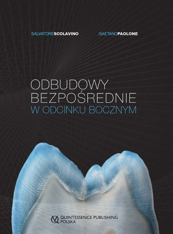 Odbudowy bezpośrednie w odcinku bocznym