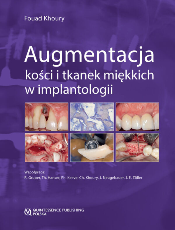 Augmentacja kości i tkanek miękkich w implantologii